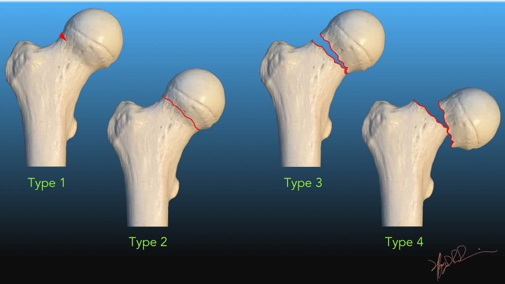 Classification de Garden des fractures du col fémoral