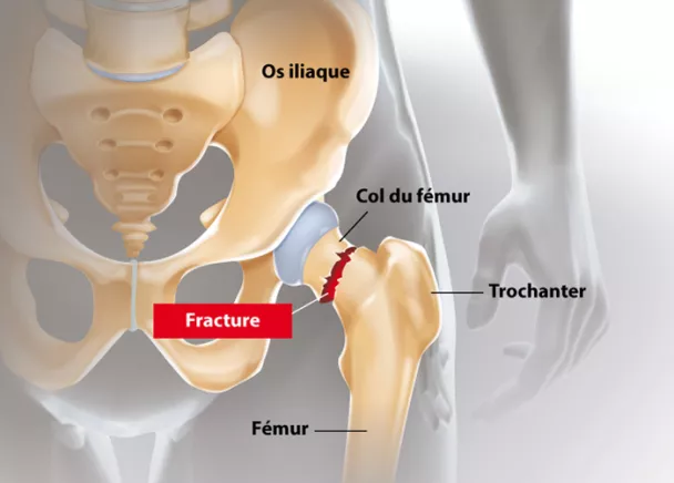 Schéma d'une fracture du col fémoral, vue 2