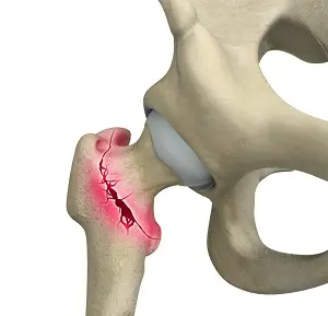Schéma de fracture pertrochantérienne, vue 2