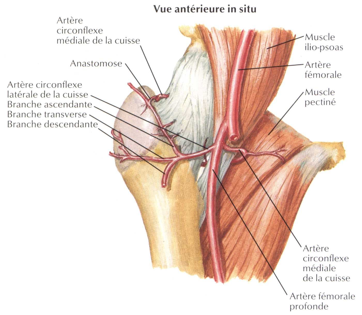 Vue anatomique d'ostéonécrose évoluée de la tête fémorale